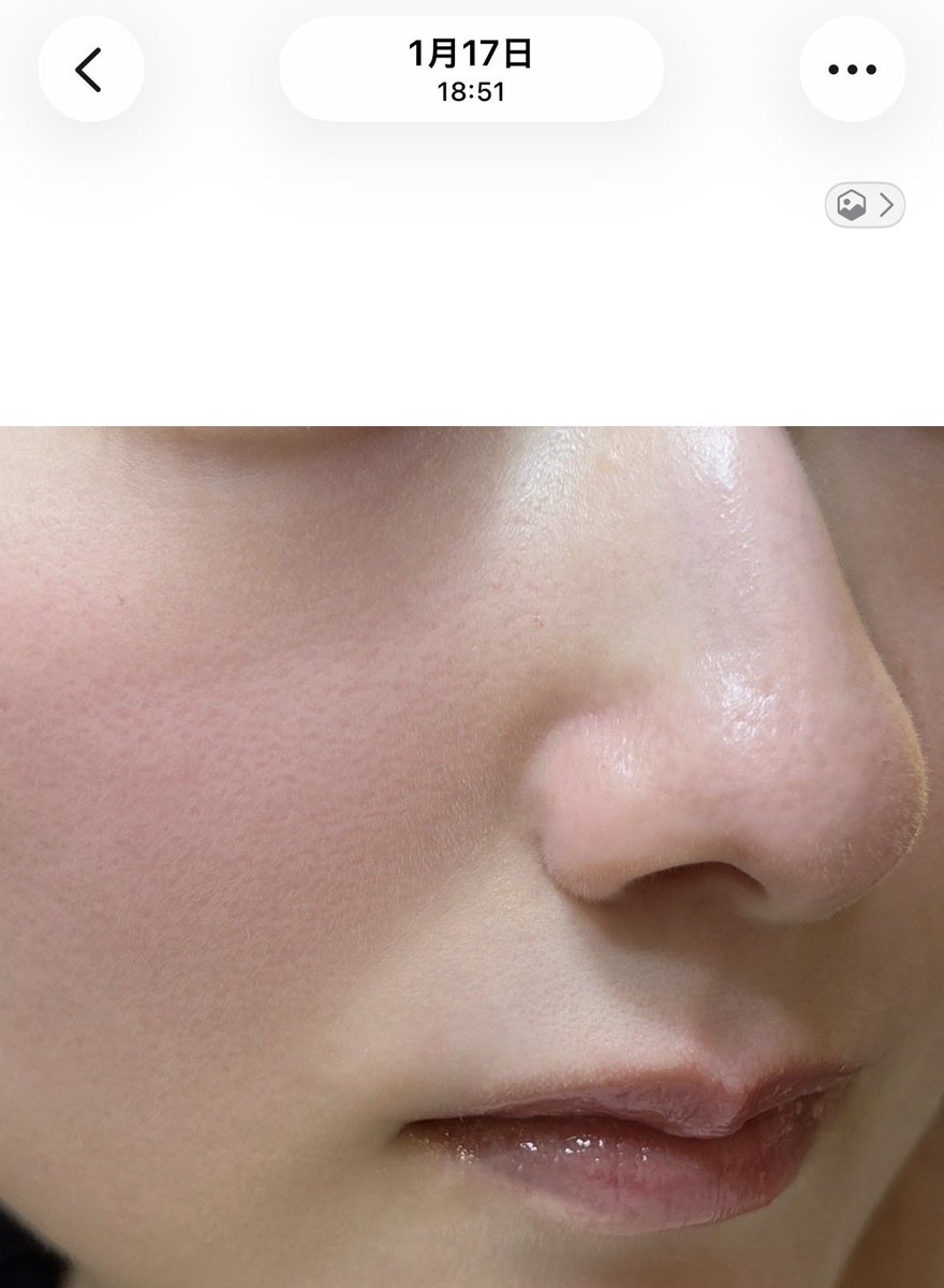 いちご鼻と小鼻の赤み、肌のくすみはかなりなくなった。どの施術を何回やったかはちゃんと数えて共有します！iPhone機種変して高画質になったから産毛と頬の毛穴までしっかり見えるけど今の方が明らかに肌綺麗。