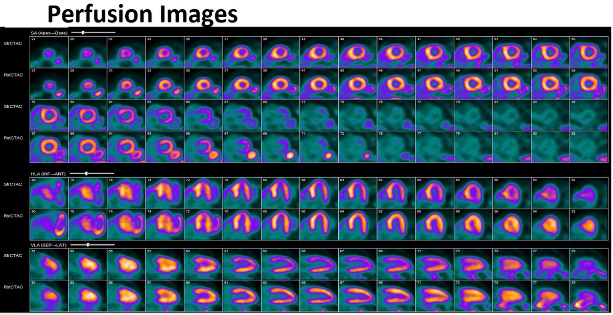 MyASNC's tweet photo. #CVNuc #ThinkPET case poll: 87-year-old male presents w chest pain. History of HTN, HLD, PAD. Physical exam unremarkable. LVEF 60%. Which of the following interpretations is most appropriate? Vote below. https://t.co/GLoYT7FeSd