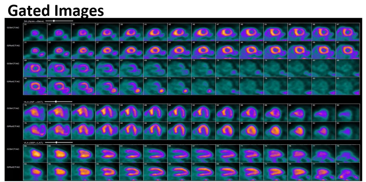 MyASNC's tweet photo. #CVNuc #ThinkPET case poll: 87-year-old male presents w chest pain. History of HTN, HLD, PAD. Physical exam unremarkable. LVEF 60%. Which of the following interpretations is most appropriate? Vote below. https://t.co/GLoYT7FeSd