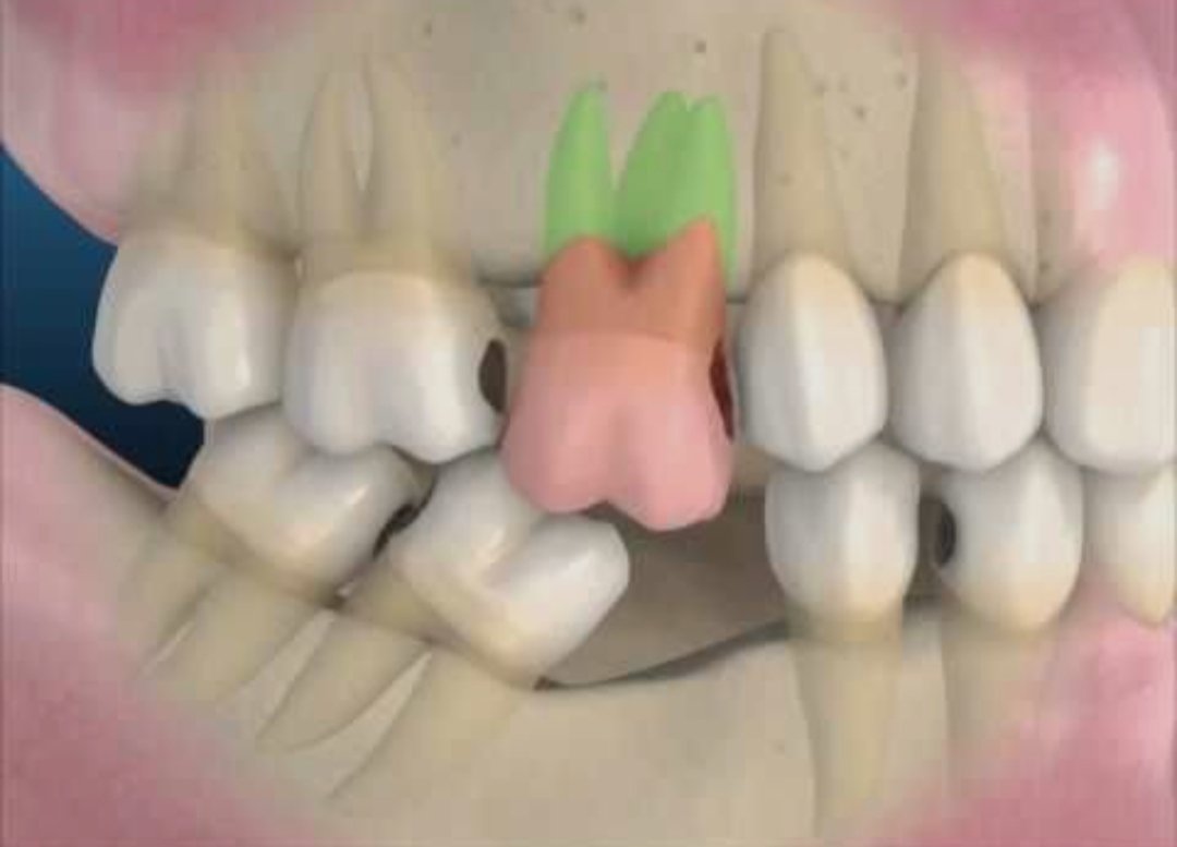 jainshilpa_'s tweet photo. How one missing tooth can wreck your whole bite?
The opposite tooth over-erupts (supraeruption) & the adjacent ones drift/tilt in. This leads to misalignment, bone issues, decay traps, harder fixes later with TMJ pain.
Don't ignore gaps, replace them timely.
#ToothLoss