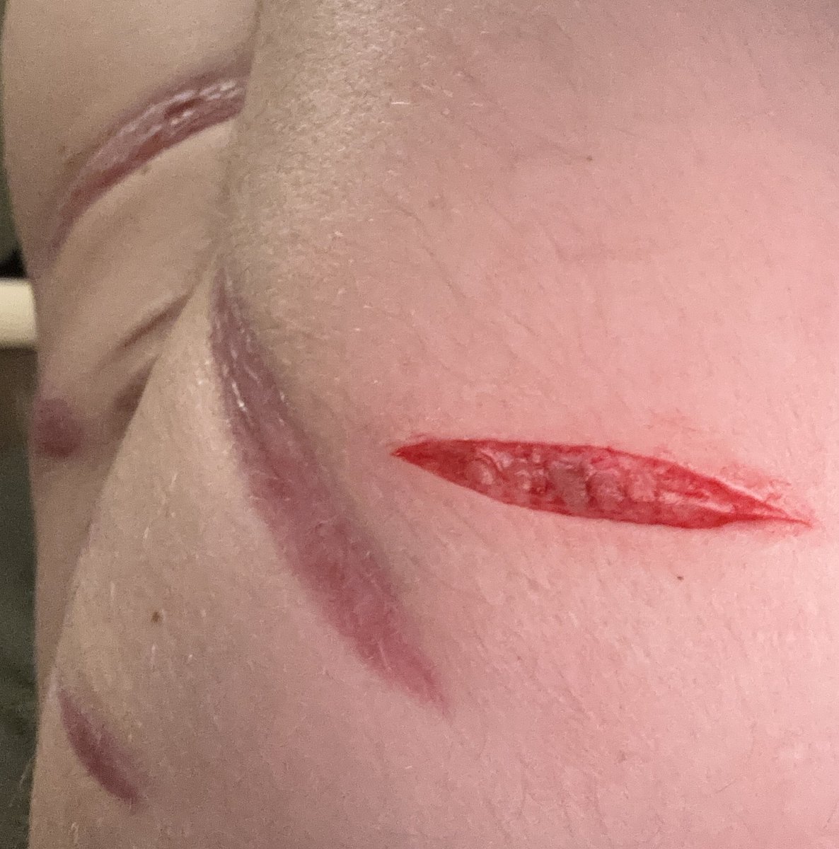 blu3_starburst's tweet photo. Sesh with the awesomest oomfie @Blot_Alien_xoxo !! Last pic is kinda scar check as well!! Also I got a vein when I did this so I couldn’t go deeper 💔💔

#shtwt #shedtwtᅠ #cutspo #oneswipe #slittwt #988twt #shspo #beanspo https://t.co/qFCJER1QGo