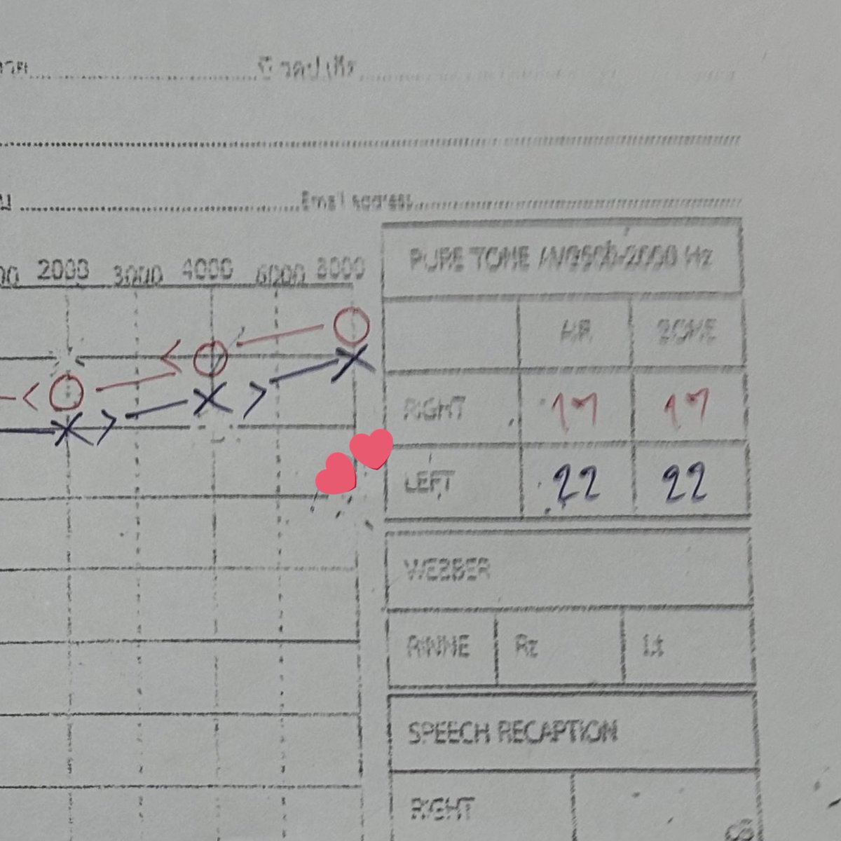 mwhowst's tweet image. เตือนภัยคนชอบใส่หูฟังบ่อยๆ❗️ตอนมหลนี่อยู่กับรูมเมทเลยใส่หูฟังทุกวัน วันละหลายชั่วโมง ตอนเรียนจบก็ยังใส่อยู่ก็ 4-5 ปี วันนี้มาหาหมอเพราะปวดหูตอนแรกคิดว่าขี้หูตันเลยจะมาดูดแต่พอส่องกล้องหูสะอาดมาก หมอเลยบอกอาจจะเป็นเส้นประสาทหู พอไปตรวจสรุปว่าเป็นเส้นประสาทหูเสื่อมจริงๆ 😔