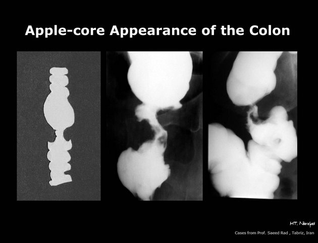 The apple core sign, also known as the napkin ring sign (bowel), is ...