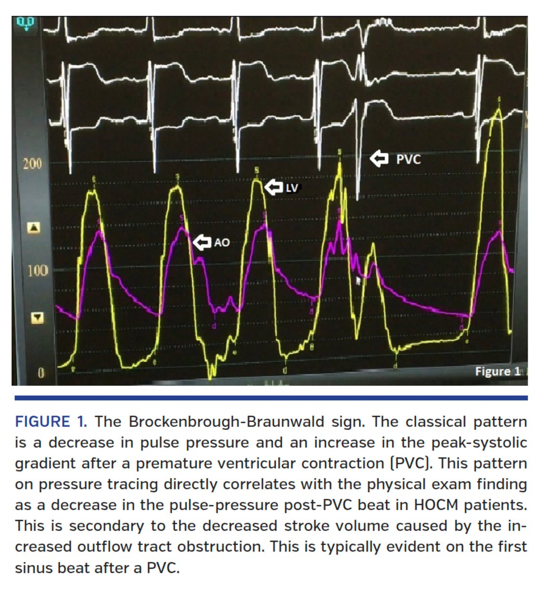 javier20ch's tweet photo. Signo de Brockenbrough en la Miocardiopatía Hipertrófica. 🫀💥
🔶️El signo de Brockenbrough-Braunwald-Morrow es un hallazgo hemodinámico clásico de la MCH obstructiva, observado tras una extrasístole ventricular durante el registro invasivo de presiones.
🔶️La EV va seguida de una pausa compensadora. En el latido post-extrasistólico: ⤴️contractilidad (potenciación post-extrasistólica), ⤴️volumen sistólico. En la MCH obstructiva esto incrementa el SAM y el gradiente dinámico del TSVI.
🔶️Hallazgo característico: ⤴️Presión sistólica del VI, ⤵️Presión sistólica aórtica. Como resultado hay un aumento del gradiente VI–Aorta, a diferencia de la estenosis aórtica fija. En las curvas de presión se observa claramente la discordancia entre VI y aorta en el latido post-EV. 🧐 🔎
🔶️Ayuda a confirmar obstrucción dinámica del TSVI. Útil para diferenciar MCH obstructiva 🆚️ estenosis aórtica. Puede aparecer o acentuarse con maniobras que ⤵️precarga o ⤴️contractilidad.

📄🆓️⤵️
https://t.co/f5iAnCT1cb