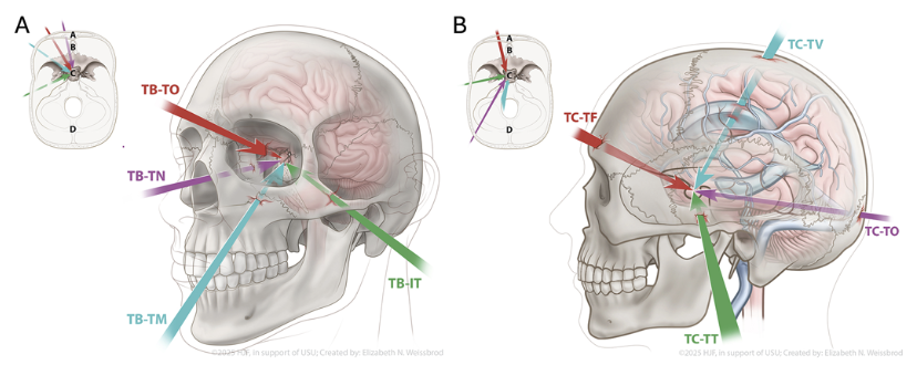 TheJNS's tweet image. #OnlineFirst: Wartime penetrating sellar/parasellar injuries: a novel classification and management based on trajectory. 

thejns.org/view/journals/…