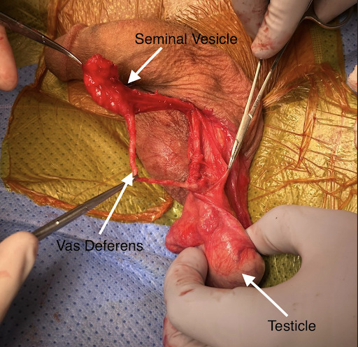 urogoldjournal's tweet photo. GOLD CHALLENGE CASE
https://t.co/E8yzXkzReh
Scrotal mass thought to be a thrombosed varicocele found to be an ectopic seminal vesicle, a rare Wolffian duct anomaly associated with male infertility #Urology #MedEd @rashedrowaiee @omerraheemmd @omaralmidani @ammar_al_homsi https://t.co/DpUqzAz7nZ