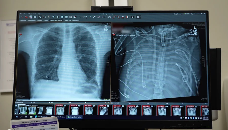 Bastante impresionante: 

Un equipo médico de la Universidad Northwestern logró mantener vivo a un hombre de 33 años durante 48 horas sin pulmones, utilizando una máquina artificial personalizada.  

El paciente llegó al hospital con una gripe B complicada con infección severa