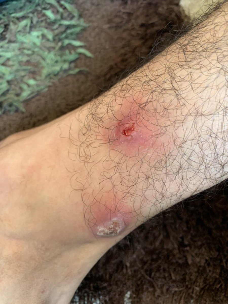 All7m_Mahmou14d's tweet image. I BEG U , DONT IGNORE FOR IMPORTANCE

I have a bacterial infection and suffer from stomach pain and chronic diarrhea due to water, air and contamination of unhealthy food. Help me get help by donating and sharing to save me🥹🙏🍉

gofund.me/d81fe6e6d