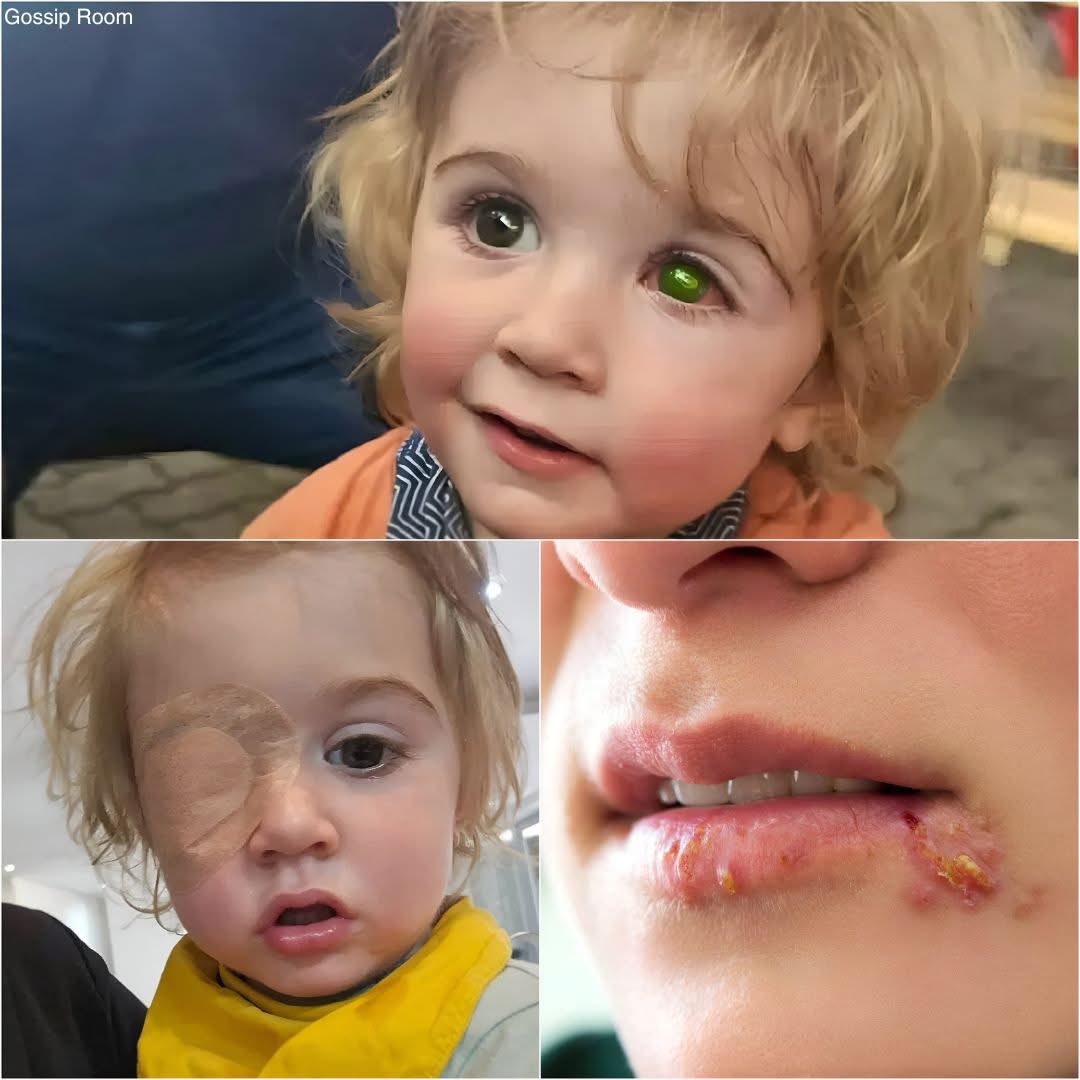 🚨 Un enfant de 2 ans, Juwan, a perdu la vue de son œil gauche après avoir été embrassé par une personne porteuse du virus de l’herpès (HSV).

Transmis à l’œil, le virus a provoqué une cloque, puis une perforation de 4 mm de la cornée, suivie d’infections graves. D’abord traitée