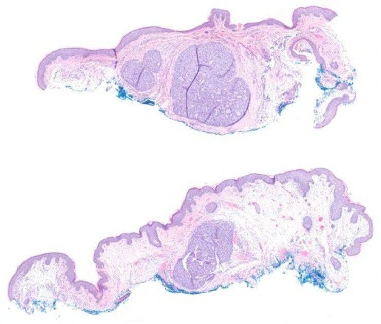 American Society of Dermatopathology tweet media
