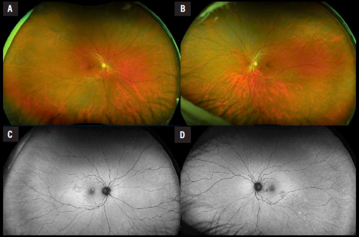 Retina Specialist tweet media
