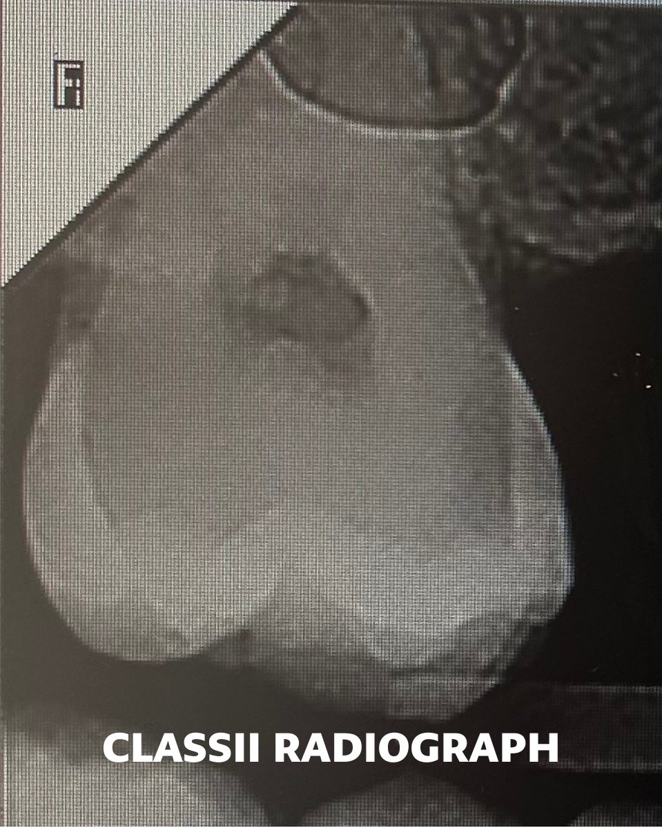 Class II composite restoration performed on tooth #17.Caries removal followed by composite resin restoration.
The cavity extended to the gingival margin, making it a super challenging case, with a satisfying final result 👏🏻