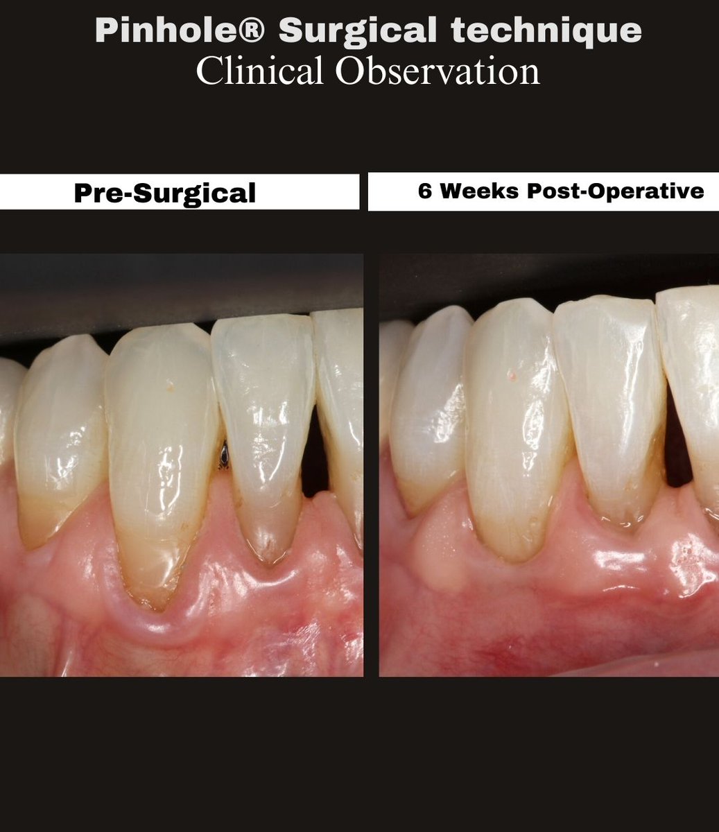 JohnChaodds's tweet photo. 6-week PST follow-up (#21–28,31): improved gingival margin position and tissue adaptation in the mandibular arch. 
Early remodeling—more maturation ahead. #pinholesurgicaltechnique #gumrecession #dental https://t.co/OACmpJabEK