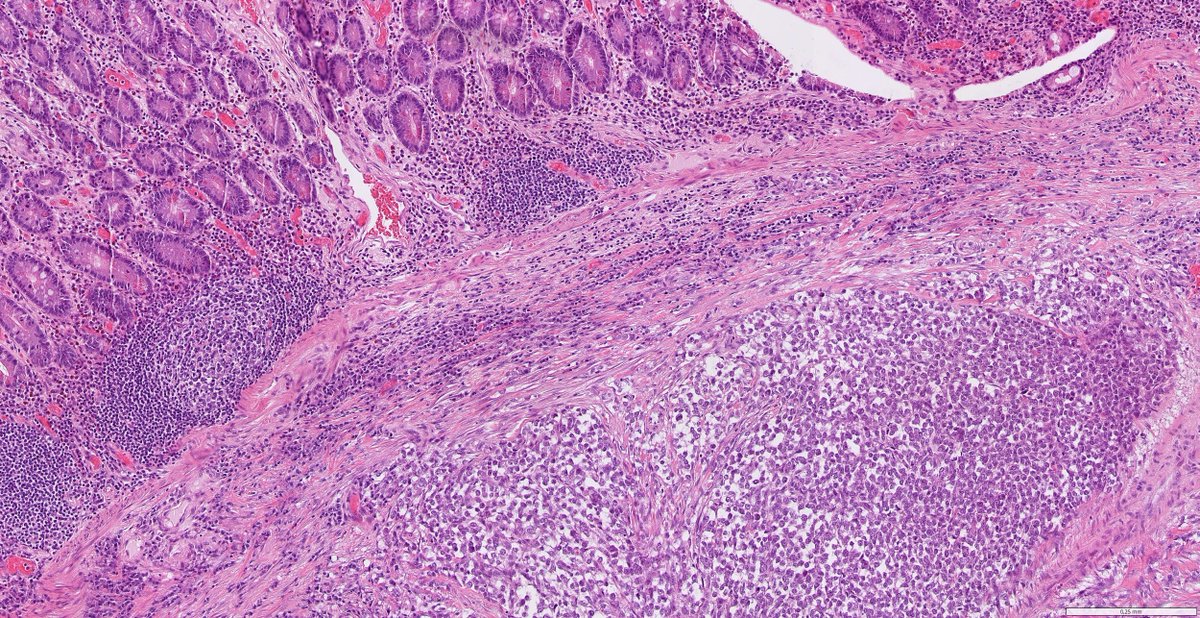 DrJuhlin's tweet image. Not everything is what it seems.

Middle-aged patient. Consult case. Minimal clinical data. Ileal resection for obstruction → tumor found.
Let’s follow the diagnostic trail. Short thread, do the polls in order (and no sneak peek...)