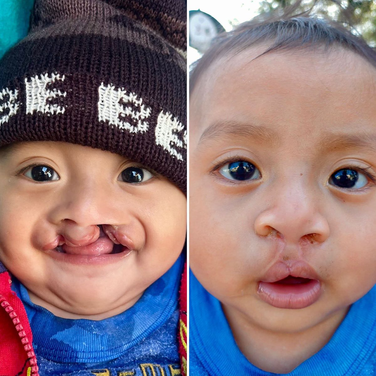 payoo241's tweet image. Before surgery vs After surgery!

A child’s smile restored by timely medical care and skilled hands.
Cleft lip and palate are treatable — early intervention changes lives permanently.

#MedTwitter #GlobalHealth #PlasticSurgery #PathTwitter