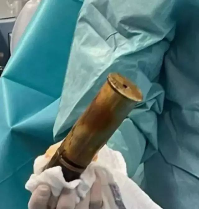 Fransa’da hastaneye gelen bir adamın poposundan, I. Dünya Savaşı’ndan kalma top mermisi çıktı.

— Hastane patlama riski nedeniyle tahliye edildi.