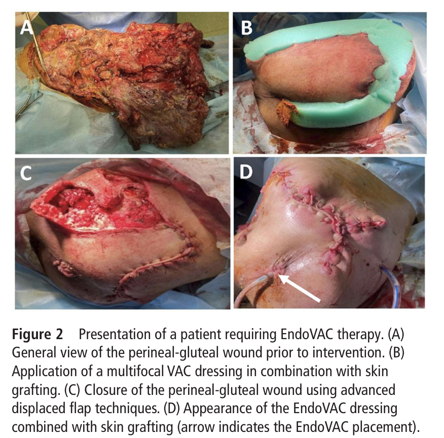 TSACO_AAST's tweet photo. There have been only a few studies of injuries from the Russo-Ukranian war in the trauma surgical literature so far.

Kondratskyi et al describe their series of extraperitoneal rectal injuries from  Kyiv (including several cases of EndoVAC use):

➡️https://t.co/9RfgjQsjfw https://t.co/xd8qYfAP5V