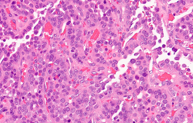 UPMCPath's tweet photo. AP case of the month: Woman in her 6th decade with progressive gait issues &amp; paresthesia. MRI showed an enhancing intradural extramedullary thoracic spinal cord mass. Previously resected and recurred after 3 yrs. Histology: pleomorphic cells, EMA+, vimentin+, Ki-67 ~20–25%. https://t.co/x6YzuenZ8F