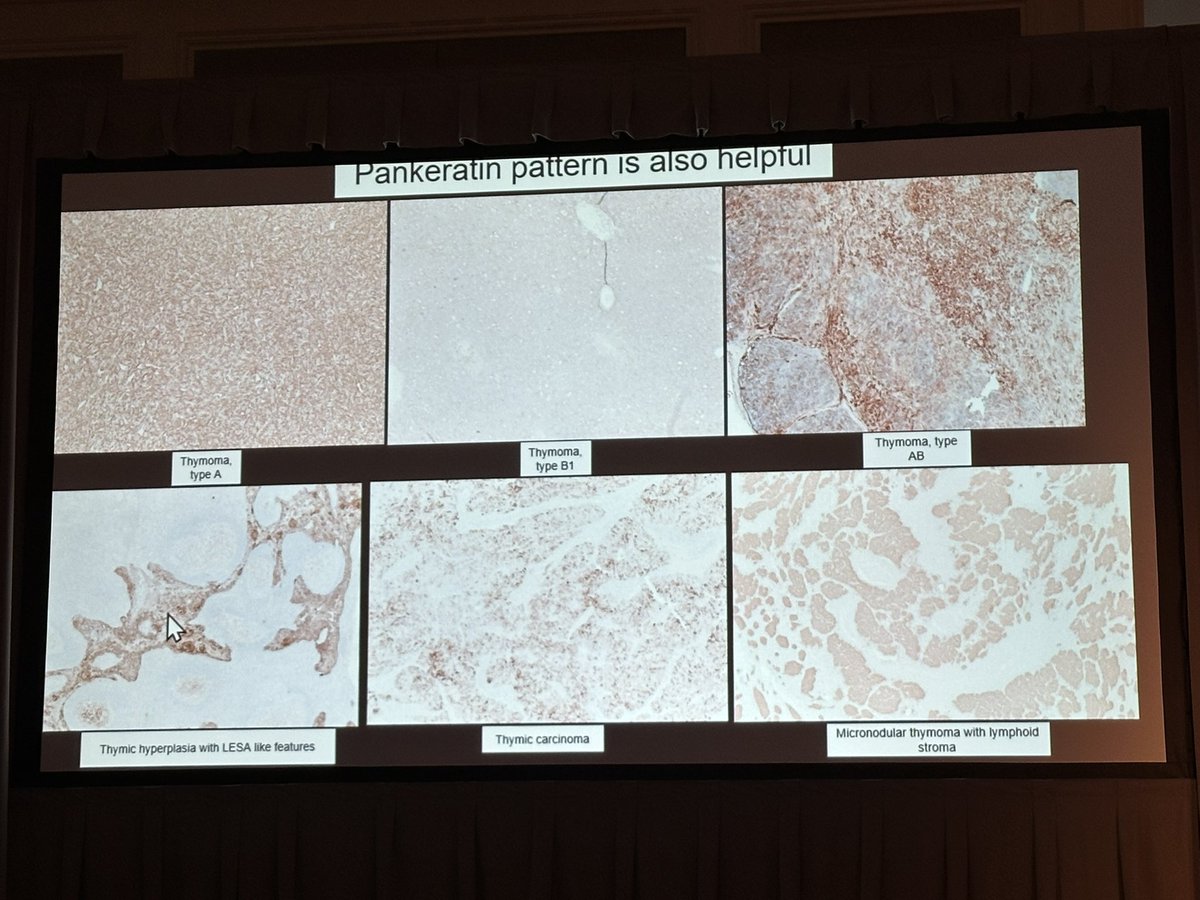 MaiElzieny's tweet photo. Highlights from CCF pathology symposium by Dr. Mukhopadhyay Mediastinal pathology: thymoma and beyond! @smlungpathguy 
#PathTwitter #Pathology #PathX https://t.co/rsbdisPfW2