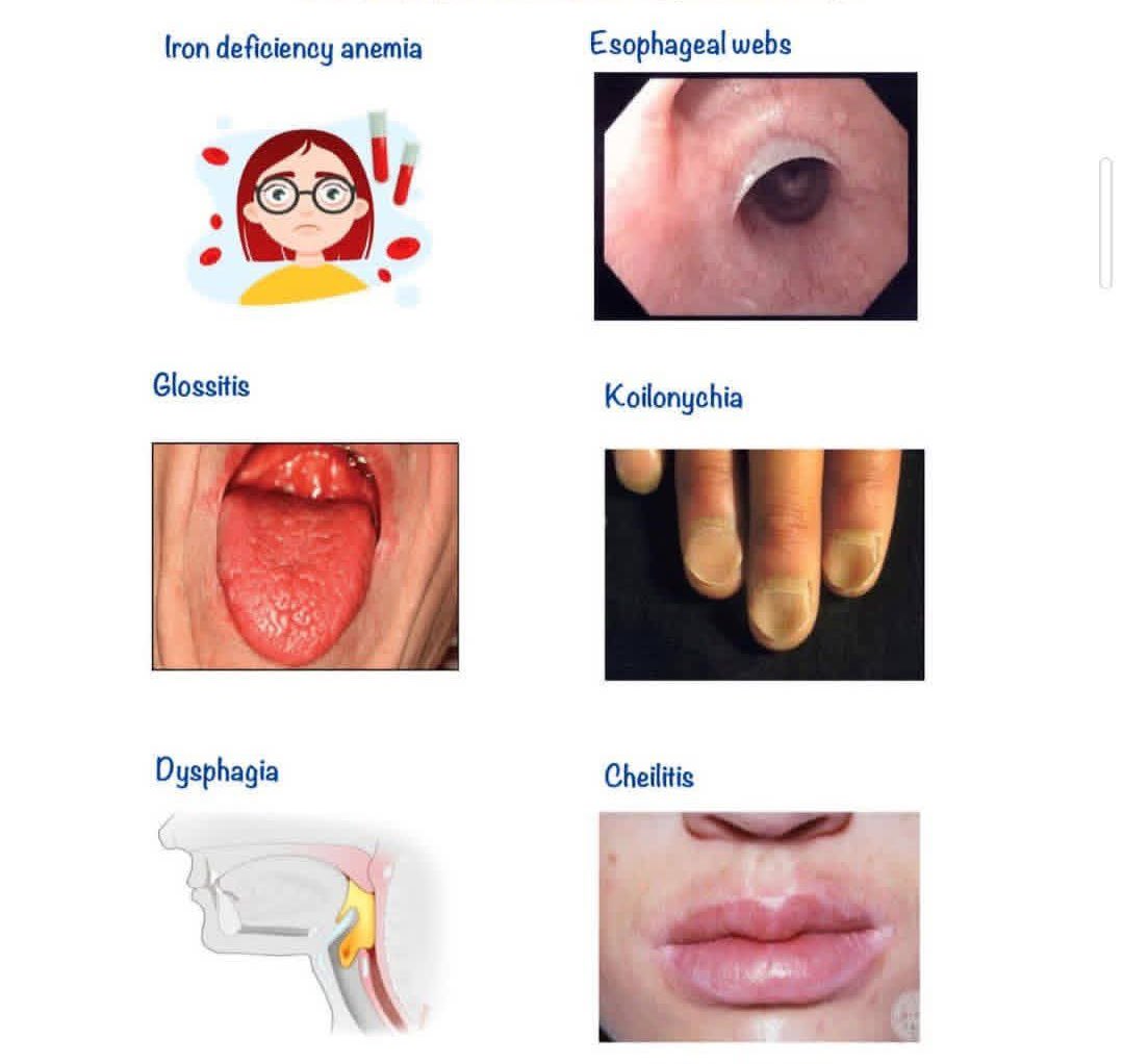 hemo_shk's tweet image. #Impression

What is the most likely diagnosis?

#MedX #MEDHM @IhabFathiSulima