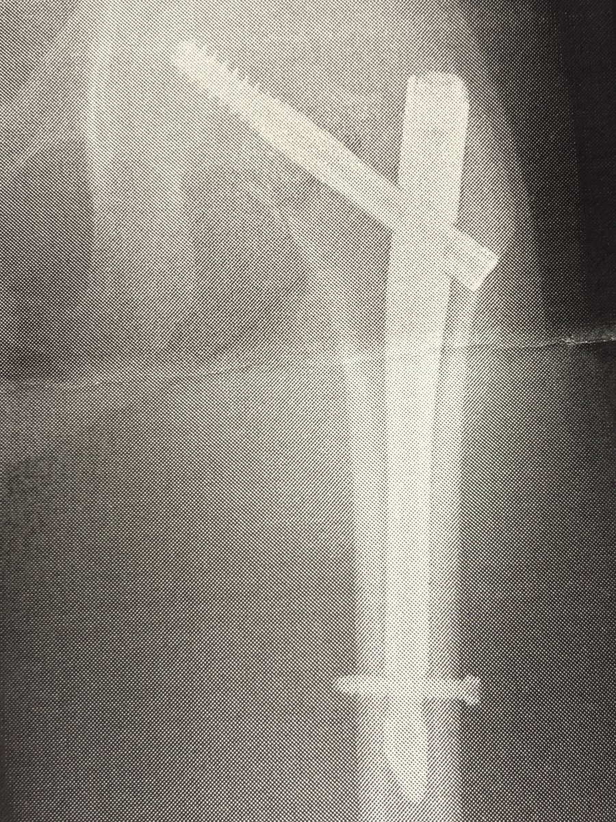 股関節の違和感が消えず、痛みが限界になったとこで再検査したところ大腿骨の疲労骨折でした。
高齢者や事故でもないと折れないとこらしいので珍しいと言われた。
バッキリいってるので手術となり、無事終わりました。

今年は白紙にしてゆっくりします。