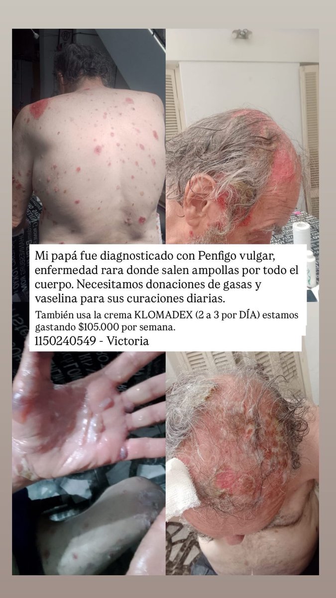 Estamos buscando donaciones de gasas, vaselina, descuento en cremas ALGO! Por favor compartan, es mi papá, fue diagnosticado con Penfigo vulgar.