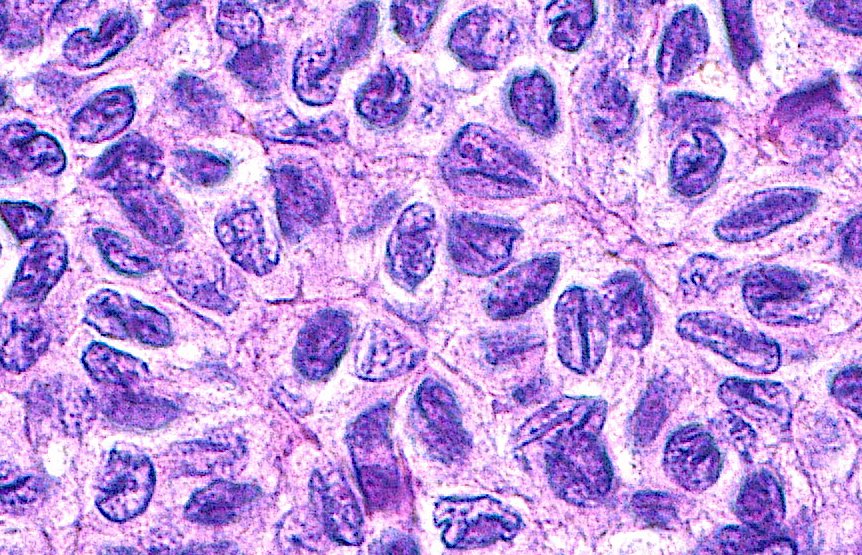 ziad_zaatari's tweet image. 🔬📸 Coffee Bean Shaped Nuclei ~ In a Granulosa Cell Tumor ~ #Pathology #Histology #GYNpath