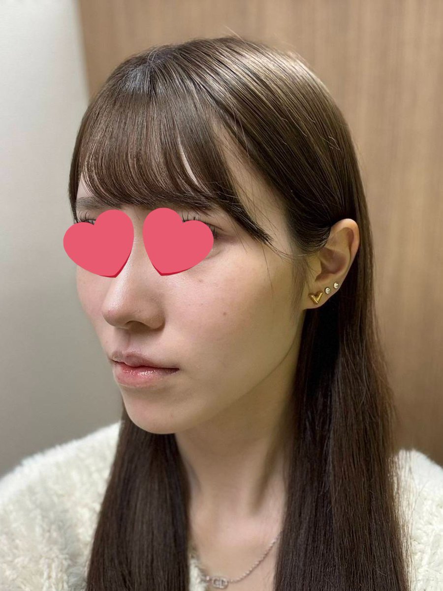 nian165's tweet photo. 🩷DA美容外科(@daprsjp)さん🩷
で輪郭3点手術をして昨日で7️⃣ヶ月が経過したので報告です🏥⋆˙⟡

術前⬅️➡️術後(7ヶ月目)
(全て無加工ポートレートです！加工🆖！)

元々コンプレックスだったゴツゴツと出っ張っていた頬骨が、今ではこんなにも滑らかなフェイスラインになってとても嬉しいですт_т♡ https://t.co/bqvsL7Groe