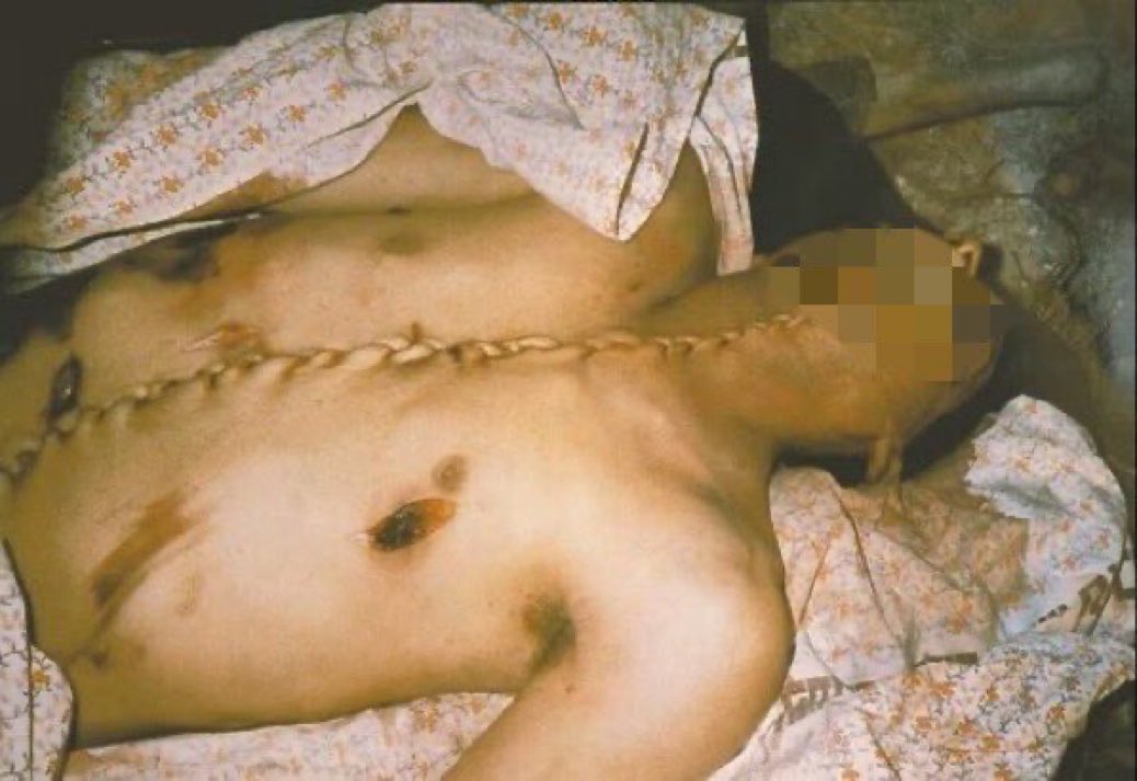 Son Dakika | yüzlerce resim ve video var 

Gazze'deki bir sağlık yetkilisi, İsrail'in böbrek bağışı rakamlarını sorguladı ve çok sayıda Filistinli cesedin organları olmadan geri gönderilmesi üzerine uluslararası soruşturma çağrısında bulundu.