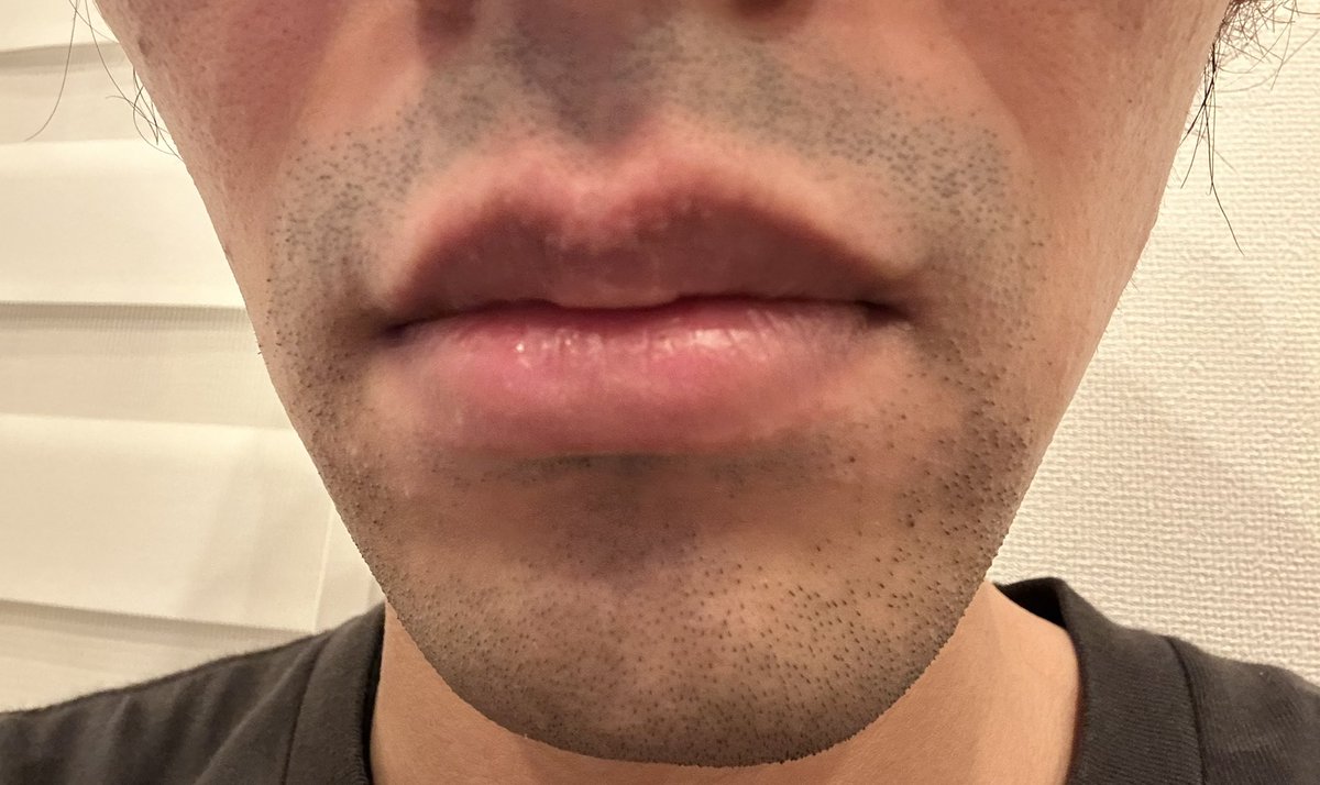 ヒゲ脱毛ビフォーアフター。 2024年5月 ← → 2026年2月女装男子として