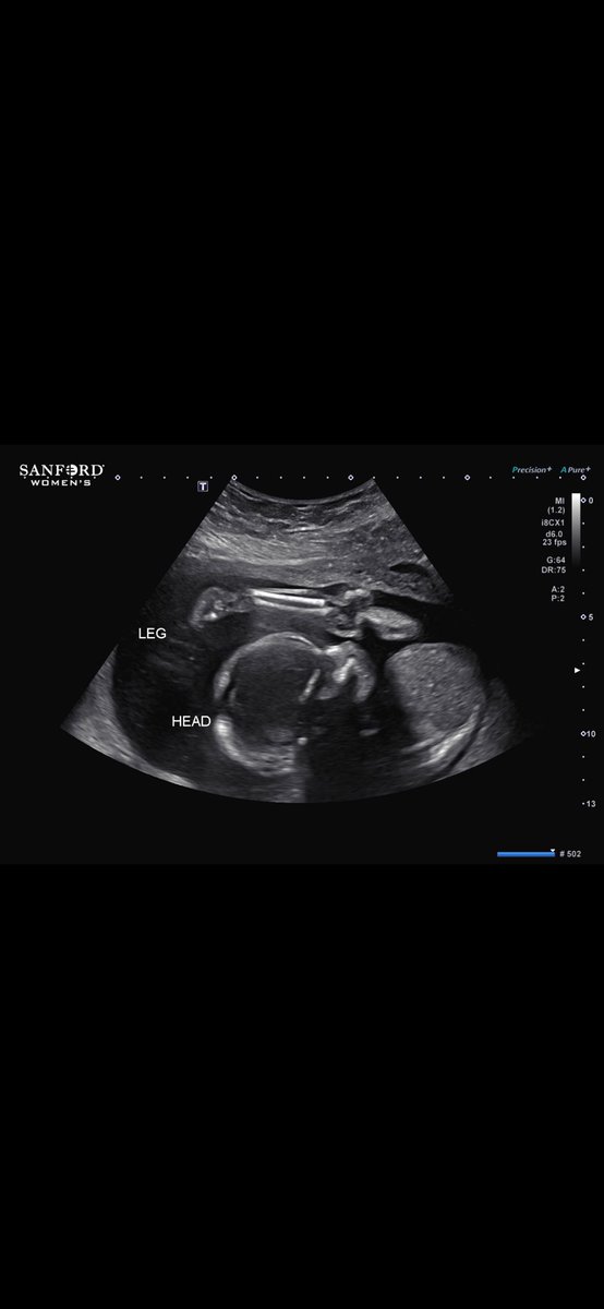 Mitchell looks like my baby’s ultrasound at 20 weeks😂

<a href="/AltitudeTV/">AltitudeTV</a> <a href="/kylekeefetv/">Kyle Keefe 🎤</a> <a href="/hoosierjm26/">John-Michael Liles</a>