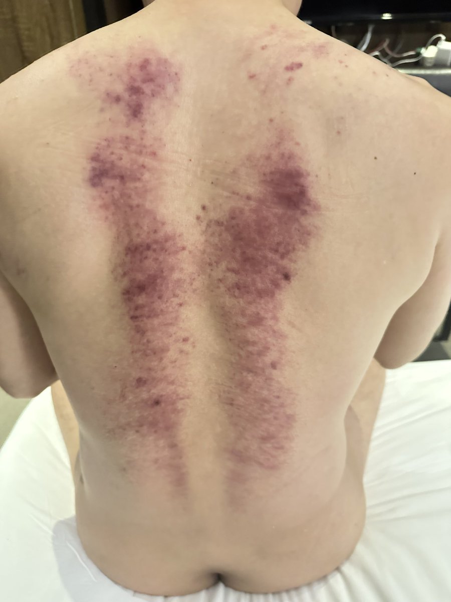 eff09333's tweet image. 謝謝台北來按摩你加購低震波課程，我懂心裡壓力讓你無法升旗典禮開始，期待這次做完後看效果如何？
其實身體壓力真的很大，心情抒發確實要說別放在心裡？
不然出痧永遠中心肺狀態很明顯，如果真的心情不開心也可以找我聊一下？
總是會有人聽見你的聲音。…