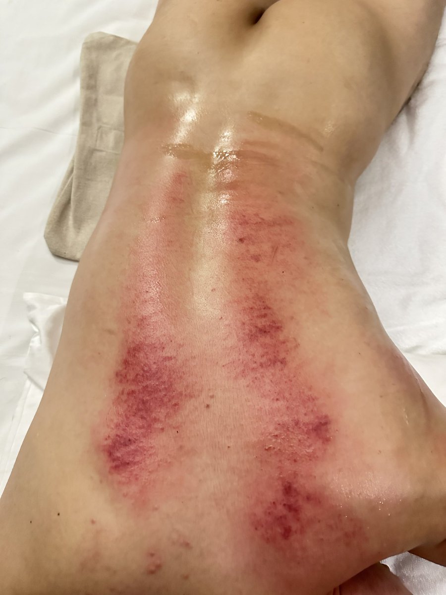 eff09333's tweet image. 謝謝台北來按摩你加購低震波課程，我懂心裡壓力讓你無法升旗典禮開始，期待這次做完後看效果如何？
其實身體壓力真的很大，心情抒發確實要說別放在心裡？
不然出痧永遠中心肺狀態很明顯，如果真的心情不開心也可以找我聊一下？
總是會有人聽見你的聲音。…