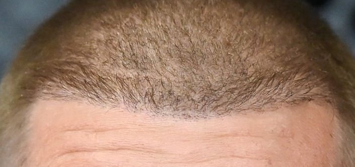 HulstNov's tweet image. I can recognize a poorly done hair transplant from a mile away.