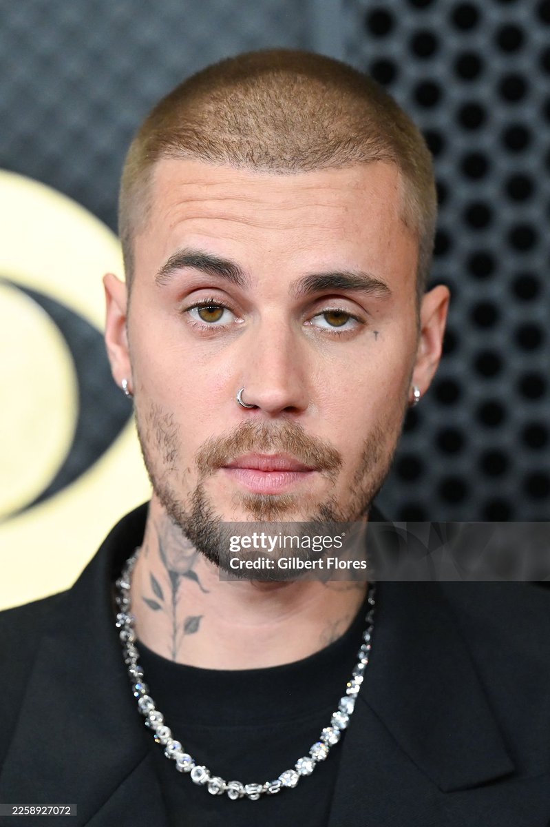 HulstNov's tweet image. I can recognize a poorly done hair transplant from a mile away.