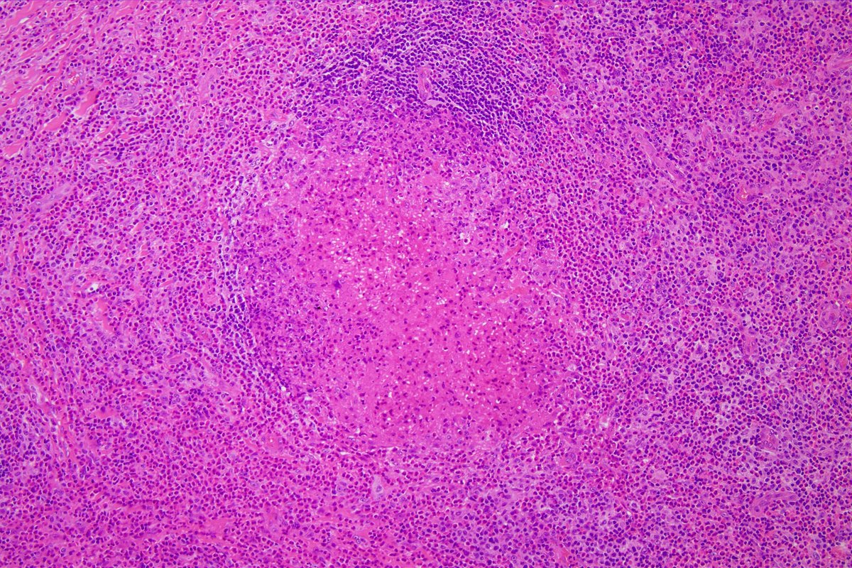 Pathology Walker@Auto Tweet Bot tweet media