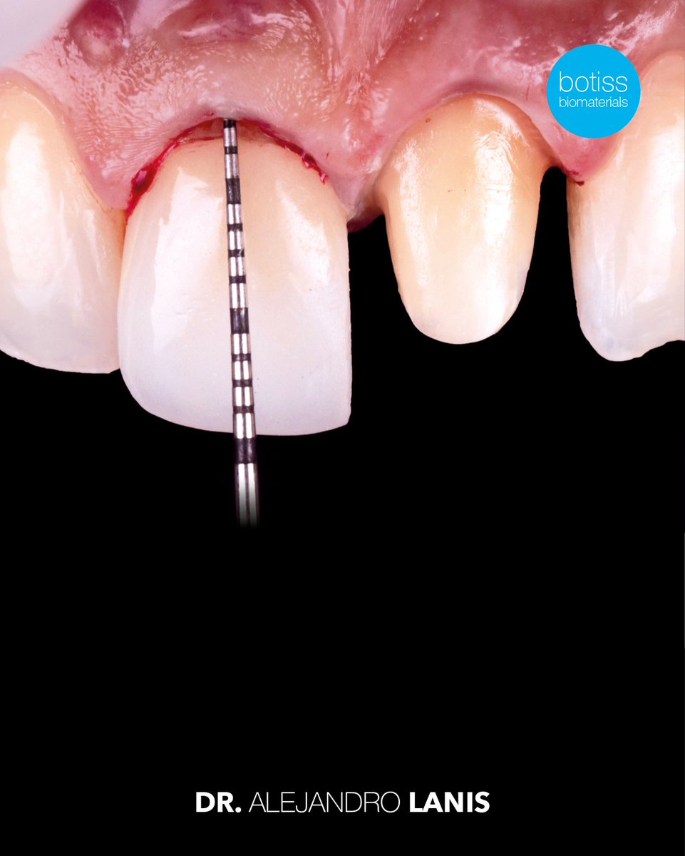 BotissB's tweet image. 🎉Congrats to Dr. Alejandro Lanis on this impressive ridge preservation with NOVAMag® SHIELD &amp;amp; cerabone® 🦷 After atraumatic extraction, the site showed stable peri‑implant bone levels, healthy soft tissue &amp;amp; a highly aesthetic result.
Read more: eu1.hubs.ly/H0rpX390
#botiss