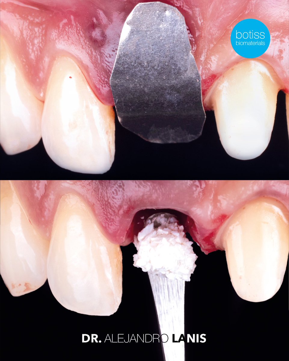 BotissB's tweet image. 🎉Congrats to Dr. Alejandro Lanis on this impressive ridge preservation with NOVAMag® SHIELD &amp;amp; cerabone® 🦷 After atraumatic extraction, the site showed stable peri‑implant bone levels, healthy soft tissue &amp;amp; a highly aesthetic result.
Read more: eu1.hubs.ly/H0rpX390
#botiss