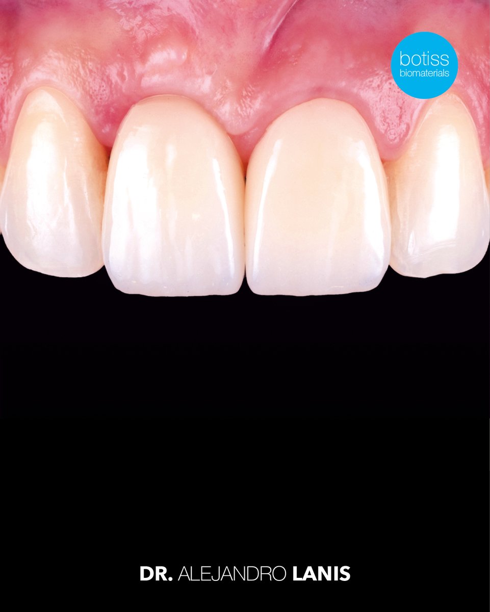 BotissB's tweet image. 🎉Congrats to Dr. Alejandro Lanis on this impressive ridge preservation with NOVAMag® SHIELD &amp;amp; cerabone® 🦷 After atraumatic extraction, the site showed stable peri‑implant bone levels, healthy soft tissue &amp;amp; a highly aesthetic result.
Read more: eu1.hubs.ly/H0rpX390
#botiss