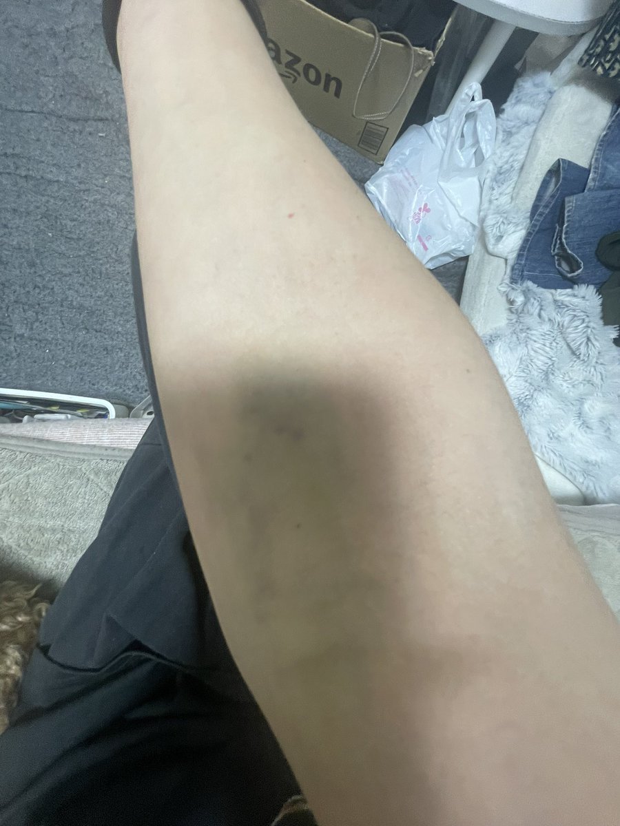kao_6014's tweet photo. 胃腸炎で死亡。
点滴打ったら腕ボロボロ https://t.co/oppR7HJR7h