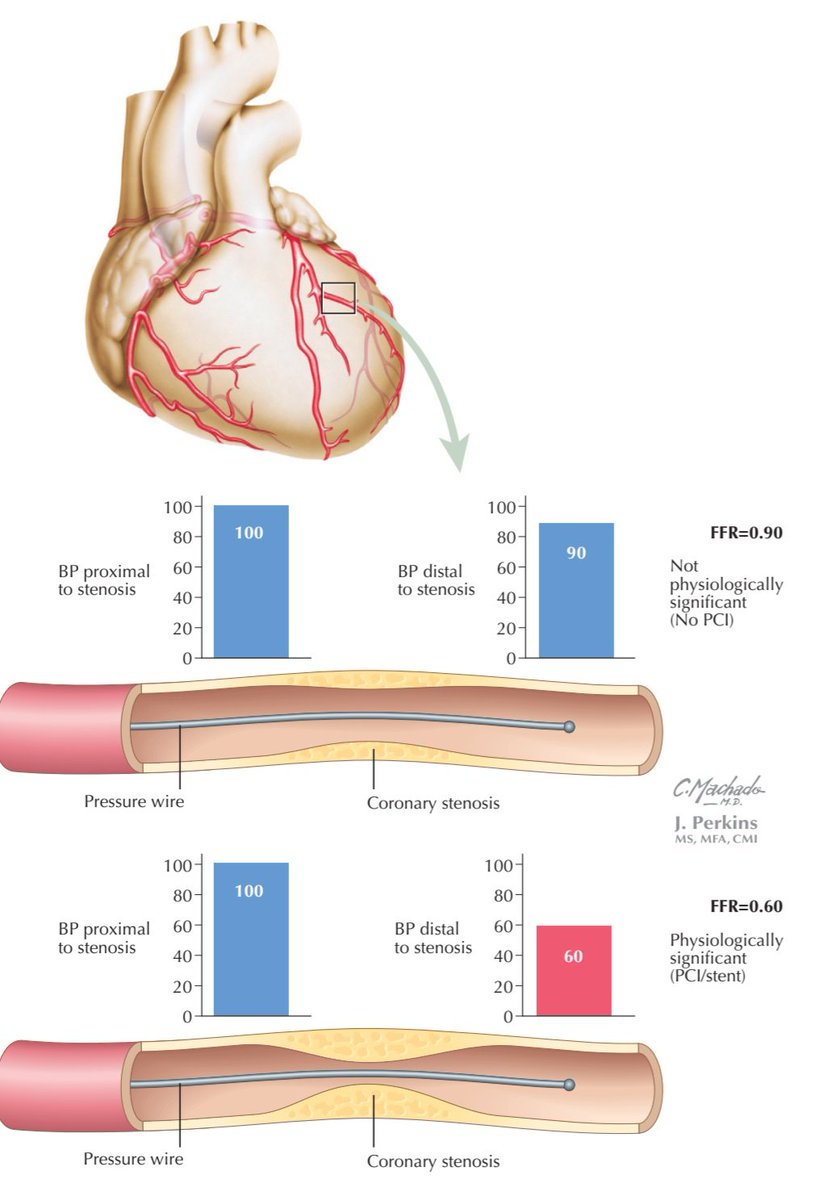 Fractional Flow Reserve (FFR): when anatomy lies, physiology speaks

Not every tight-looking coronary lesion needs a stent.

That’s where FFR changes the game.

In the cath lab, a pressure wire is passed across a coronary stenosis and measurements are taken during maximal