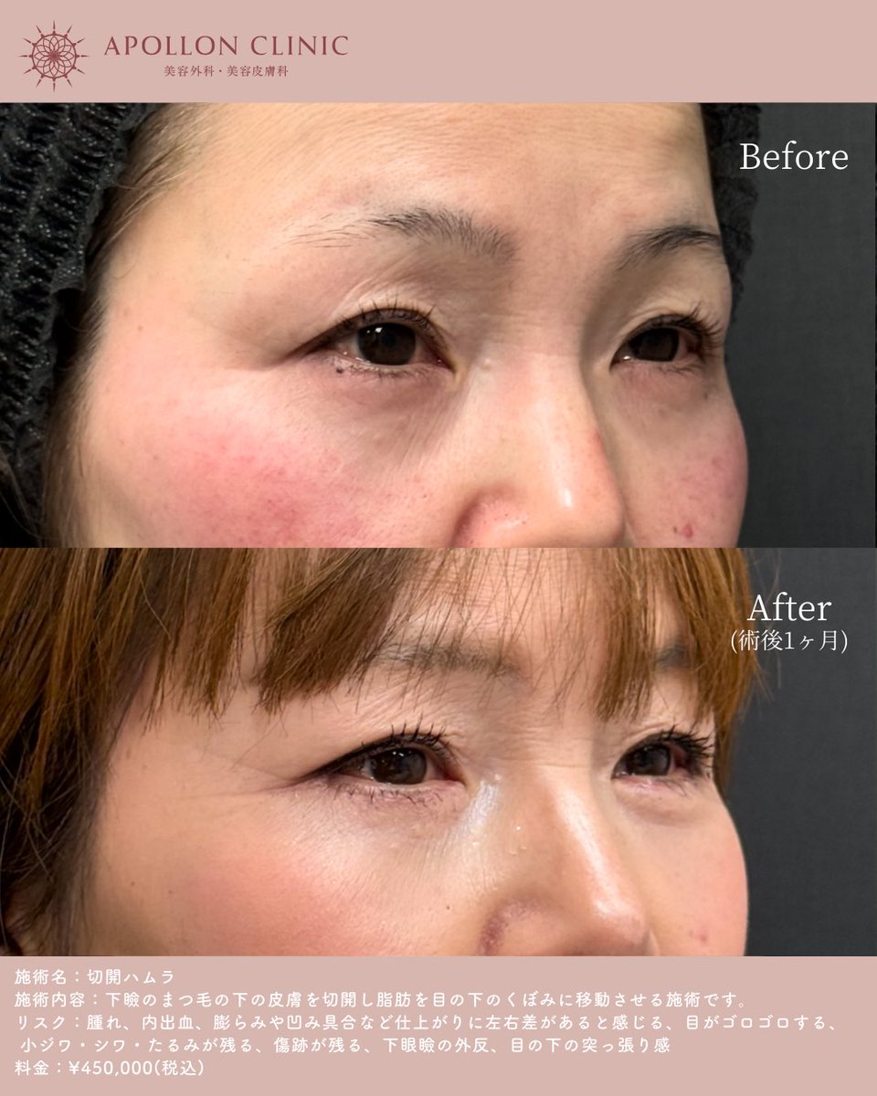 ApollonClinic's tweet photo. 切開ハムラ法では、
余っている脂肪を適切な位置へ移動し、
凹みと膨らみを同時に整えます✨
影が消えることで、
表情まで明るく見える自然な変化を🪽 https://t.co/VTzahK11pN