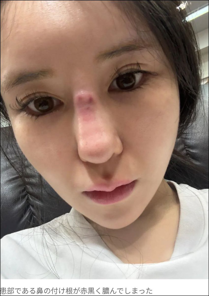 pgjbdmtmaw_'s tweet photo. ニュースにもなってるベリーグッド美容外科がインフルエンサーも通う鼻の名医なわけないゆ💢割引ありますとかマージン誘導やめろ被害者ふやすなゆ悪質インフルエンサーPR https://t.co/OWiJ9gvpFU