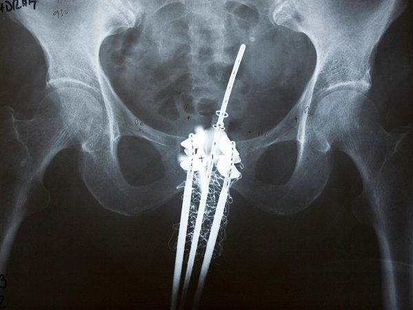 KarangwaChri's tweet photo. Rwanda is officially launching Brachytherapy, a major step forward in the fight against cancer. 🇷🇼🎯
Until now, hospitals like Butaro and Kanombe mainly used external Radiotherapy—where a machine beams radiation from outside the body.
Brachytherapy is different. It involves placing a ‘tube’ inside the body, right where the cancer is.
The benefits;
🔹 Precision: It targets the tumor directly, minimizing damage to healthy organs.
🔹 Results: Higher recovery rates because the radiation is concentrated exactly where it’s needed.
🔹 Access: Doctors at Kanombe Military Hospital are already trained, and it will be covered under Mutuelle de Santé.
Rwanda is on a mission to eliminate cervical cancer by 2027. We are currently at:
✅ 90% vaccination coverage.
✅ 81% screening/follow-up rate.
The tech is here, But the RBC’s message is simple: Don't wait. Early screening is what actually saves lives. 📢🩸
#Rwanda #CancerFree2027