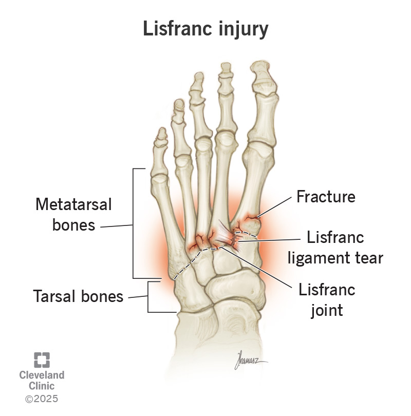 TalkingBallTM's tweet photo. 🚨 🔴⚪️ Amid reports surrounding Mikel Merino and a possible Lisfranc injury, understanding the issue is important. 

Lisfranc injuries affect the midfoot joints and ligaments connecting the forefoot and midfoot - widely regarded as one of football’s more complex foot injuries. https://t.co/HFiT9i7DbX