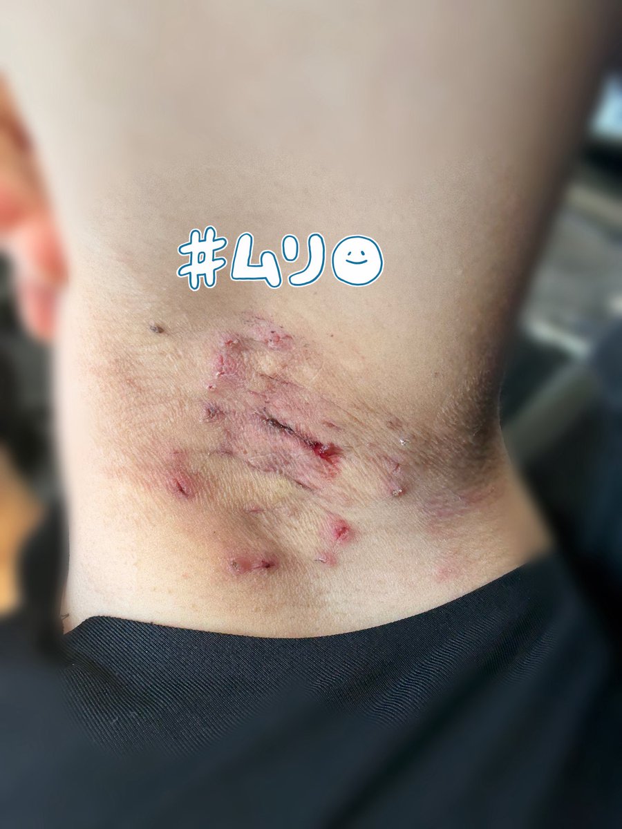 y2lu_'s tweet photo. ワキガ手術皮弁法7日目抜糸
圧迫ガーゼとテープからの解放🥺傷跡はグロいので自己責任で🥺抜糸は一箇所だけ痛い所あったけど他無痛。抜糸よりテープ剥がす方が痛かった。テープの所少しかぶれて乾燥してる。反対側の脇の時は何も処方されなかったけど今回ヘパリン出てた。脇と脂肪吸引の痣にも塗ってる https://t.co/j8MAG06HND