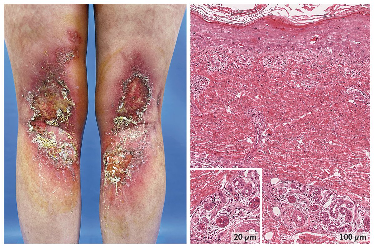 NEJM's tweet image. Images in Clinical Medicine: Toxic Erythema of Chemotherapy nej.md/3Z12cvc 

#Oncology #DermTwitter
