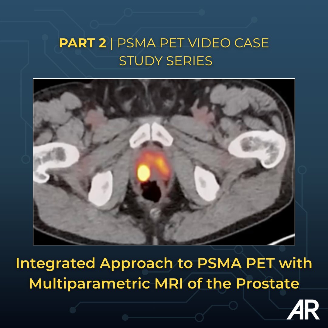 Applied_Rad's tweet photo. Part 2 of Louis Mazzarelli MD's PSMA PET Video Case Study Series focuses on an integrated approach to PSMA PET with multiparametric MRI of the prostate.

▶️ Watch Part 2 of the PSMA PET Video Case Study Series: https://t.co/mYjKkGMVIA

#PSMAPET #Radiology #CaseSeries #ProstateCancer #MolecularImaging #PETCT #RadEd #MedEd