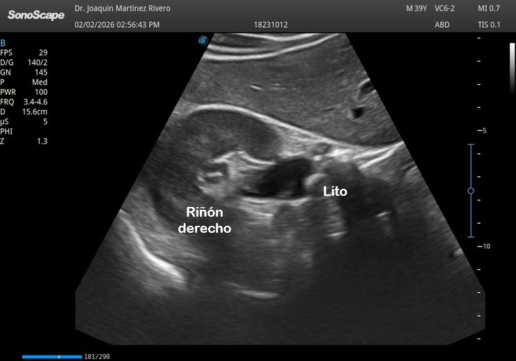 JMMR83's tweet photo. Litiasis pieloureteral derecha 
@NephroP @OswaldoRamosN @javiteigell @y_interna @yaletung @SonoSamMD @curromir @zbriote @PierpaDiNick @ABCDEcografia @ignaciomsb @jpalacinp @jorgezzb @AlvarezHigueras @mberchid @EcosemfyC @USPed_Latam @GTEcoPed @GTECOSEMI https://t.co/hiKMZSkvVy