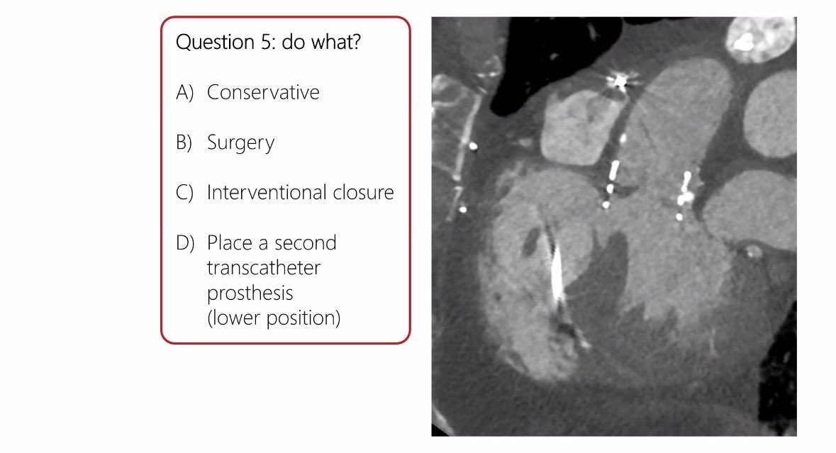 hvanspall's tweet image. Brilliant interactive #GrandRounds at #McMasterU by Prof Stephan Achenbach
on #CardiacCT

Benefits:
-Spatial &amp;amp; temporal resolution perfect for structural interventions
-Calcium accurately depicted 
-🫀devices not major problem
Limitations
-RA visualization 
- blooming artifact